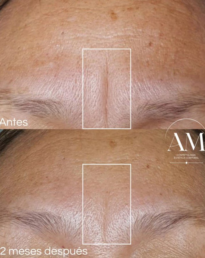 Antes y después - Protocolo corporal