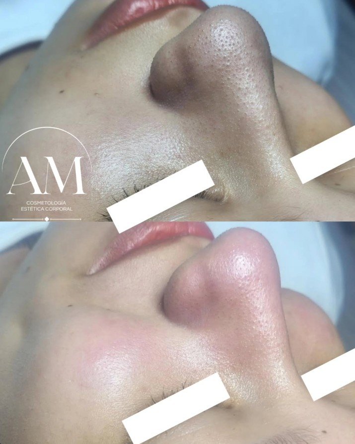 Antes y después - Tratamiento facial